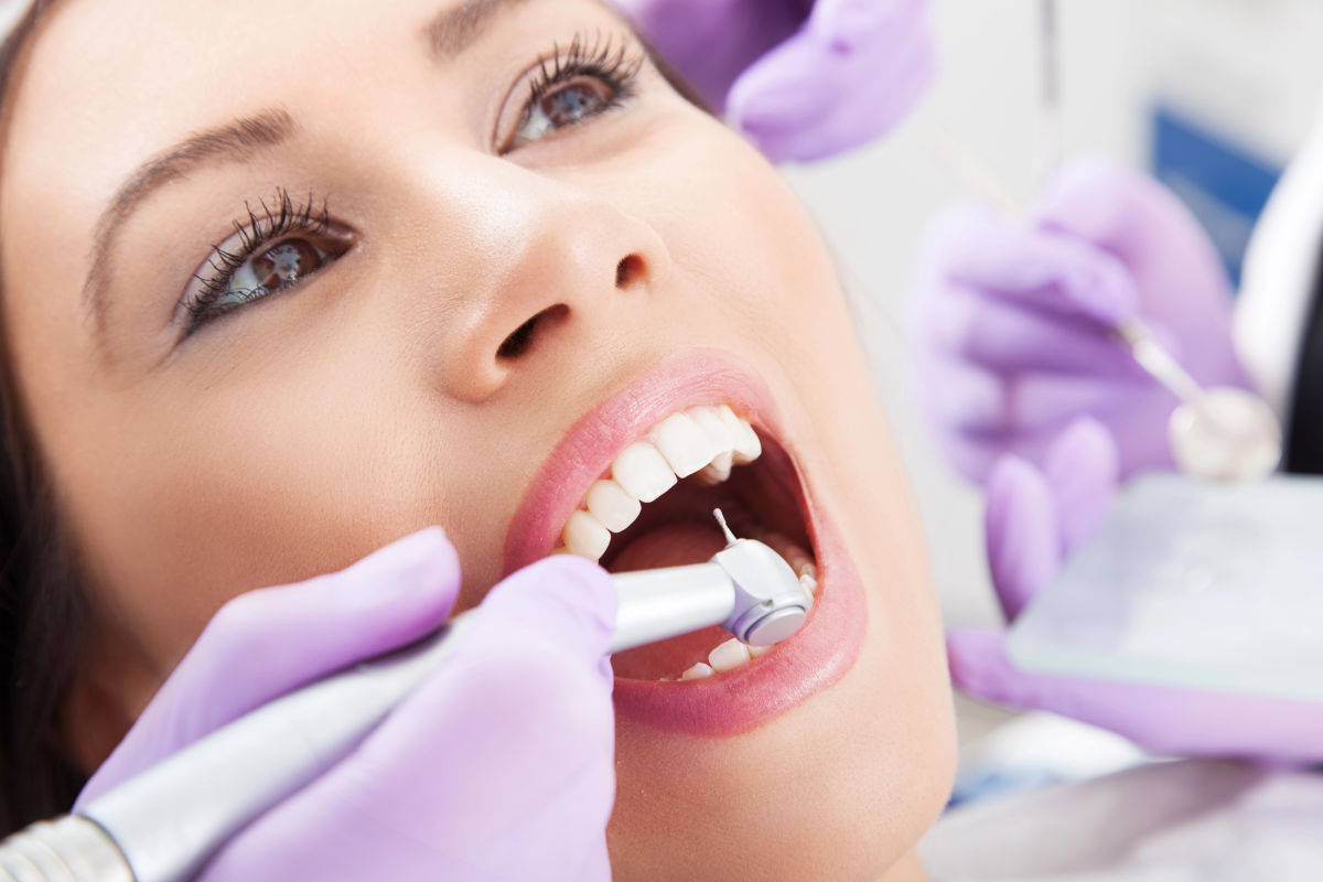 Le Stripping Dentaire (IPR) pour Invisalign : Guide Complet